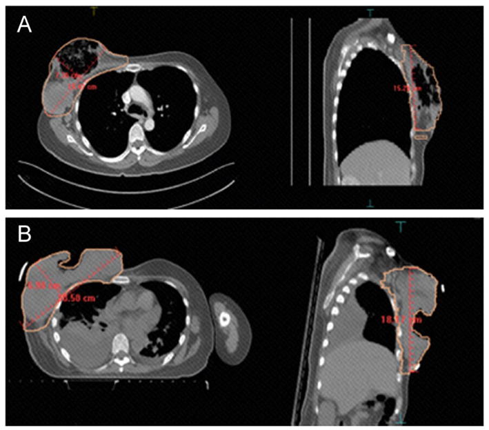 How a Special Salvage Radiation Treatment Helped Stop Bleeding and Shrink a Large, Painful Breast Tumor