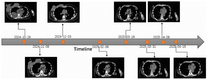 How a Special Salvage Radiation Treatment Helped Stop Bleeding and Shrink a Large, Painful Breast Tumor